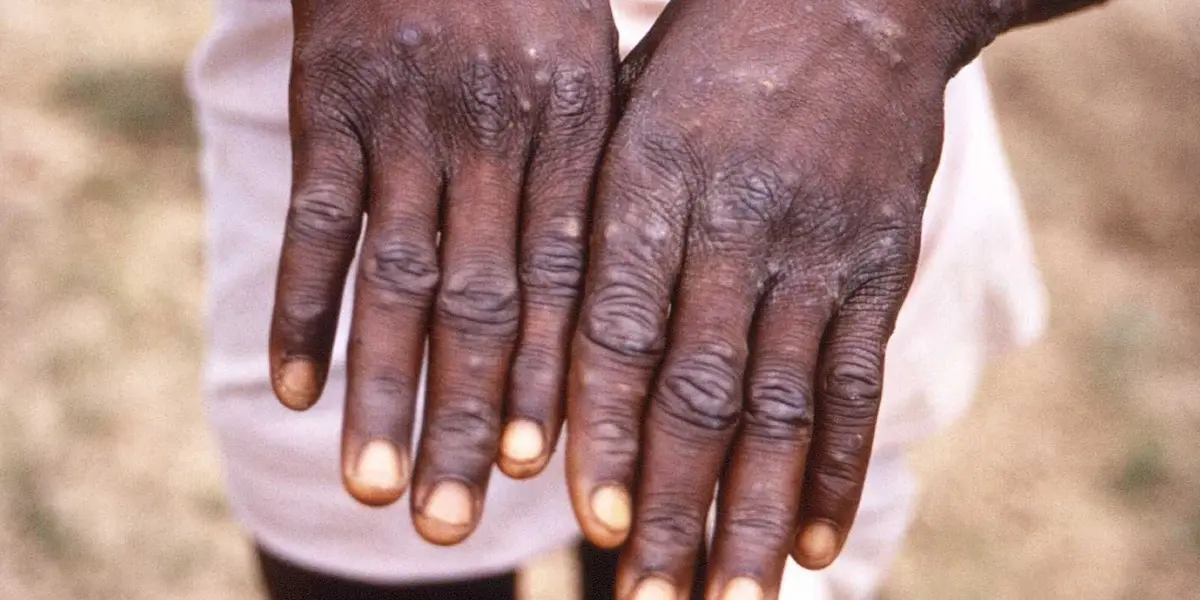 Algunas recomendaciones para evitar el contagio de la viruelas son parecidas a las del Covid, pero hay otras, recomendadas por instituciones como la máxima autoridad sanitaria británica, UKHSA