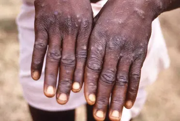 Algunas recomendaciones para evitar el contagio de la viruelas son parecidas a las del Covid, pero hay otras, recomendadas por instituciones como la máxima autoridad sanitaria británica, UKHSA